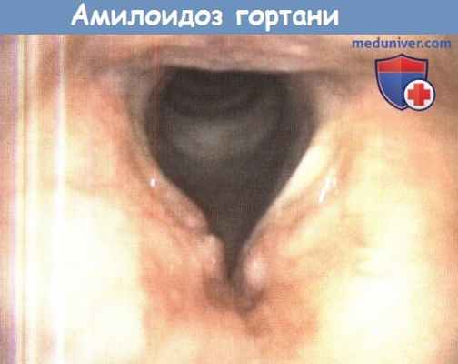 Амилоидоз гортани