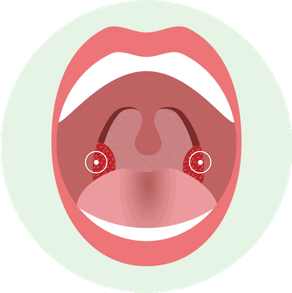 Как выглядит Фолликулярная форма острого тонзиллита