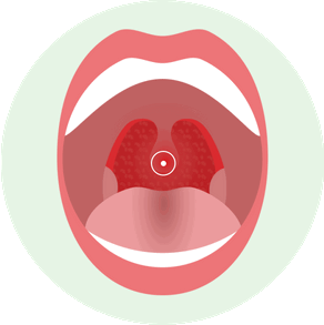 Как выглядит катаральная форма острого тонзиллита