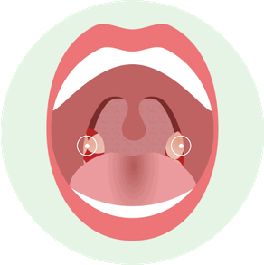 Как выглядит Лакунарная форма острого тонзиллита