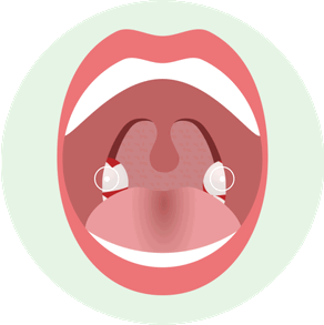 Как выглядит Фибринозная форма острого тонзиллита