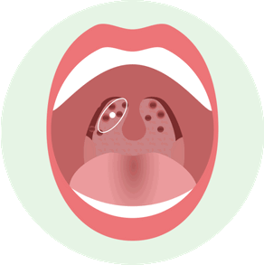 Как выглядит Герпетическая форма острого тонзиллита