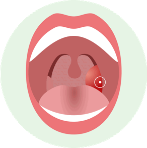 Как выглядит Флегмонозная форма острого тонзиллита
