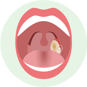 Как выглядит Язвено-некротическая форма острого тонзиллита