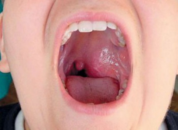 Ангиофиброма носа