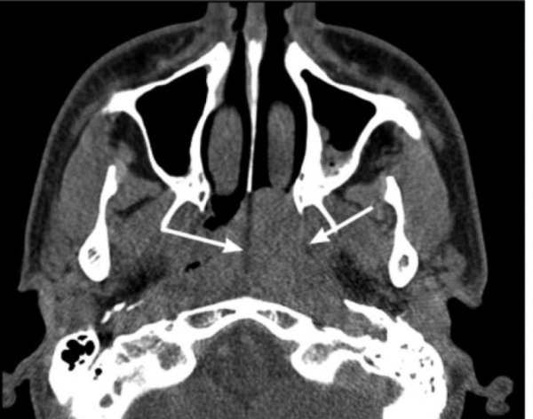 Ангиофиброма лица