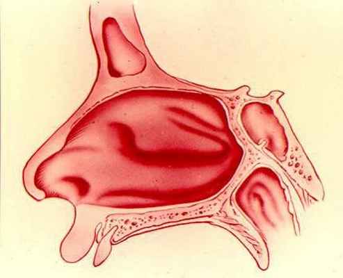 Атрезия хоан