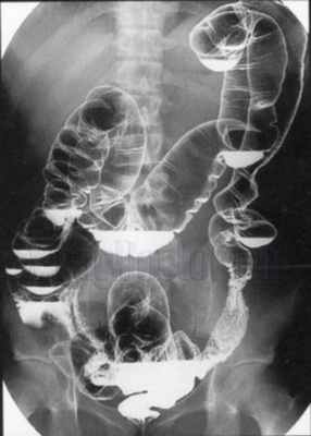 Рентгенограмма желудка