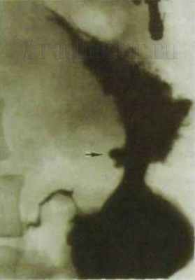 фото рентгенограммы желудка