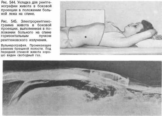 укладка пациента для рентгенографии живота в боковой проекции