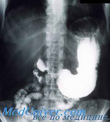 дефект наполнения на рентгенограмме