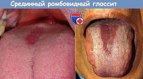 Срединный ромбовидный глоссит