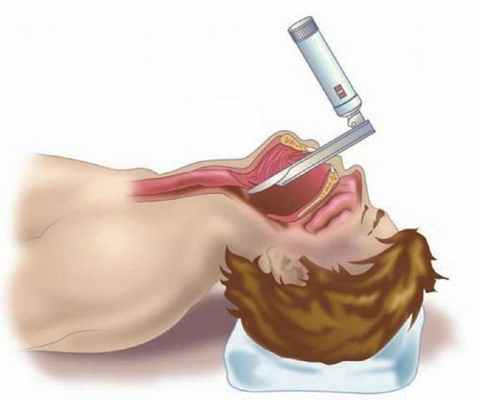 Жёсткая ларингоскопия