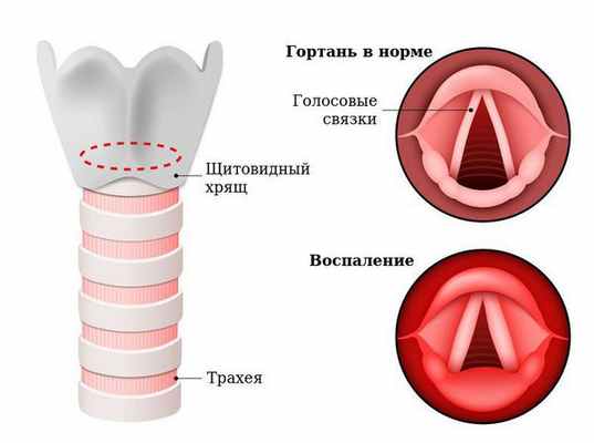 Воспаление слизистой оболочки гортани