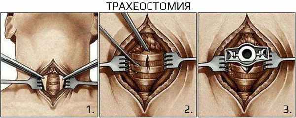 Трахеостомия