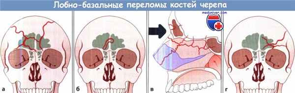 Лобно-базальные переломы костей черепа