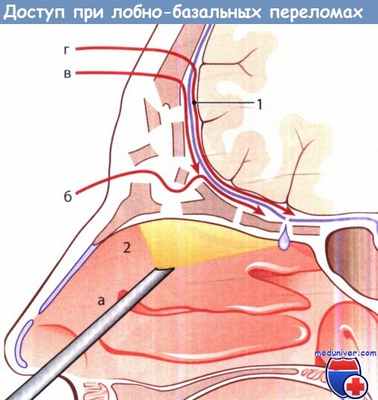 Доступ при лобно-базальных переломах
