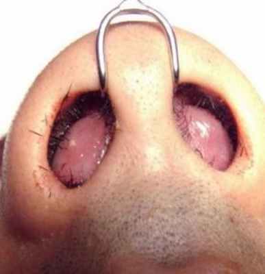 Гематома и абсцесс носовой перегородки