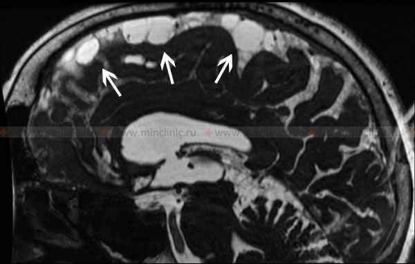 МРТ головного мозга в T2 режиме демонстрирует скопление спинномозговой жидкости в конвекситальном пространстве при церебральном арахноидите (указано стрелками).
