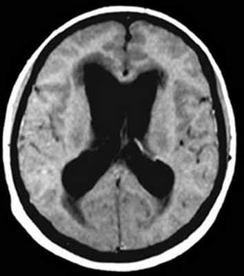 Увеличенные боковые желудочке на МРТ головного мозга при гидроцефалии с арахноидитом оболочек головного мозга.