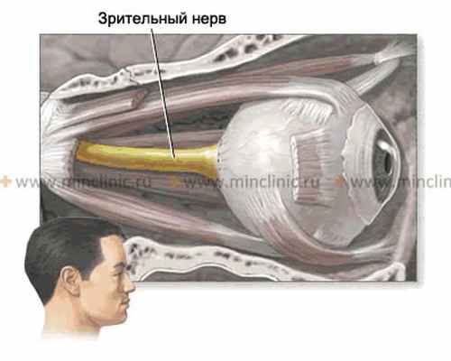 На зрительные нервы при оптико-хиазмальном арахноидите оказывают воздействие механические факторы (сдавление спайкам), а также переход на их миелиновую оболочку воспалительного процесса и расстройство кровообращения.