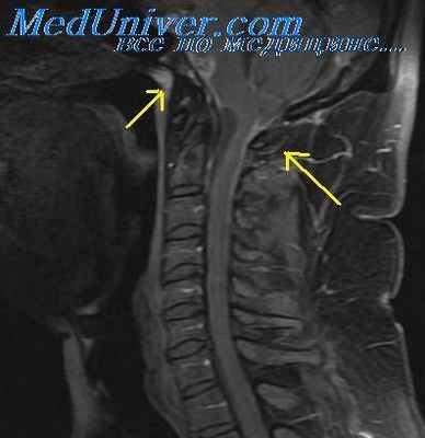 отогенный арахноидит
