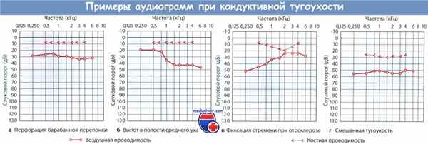 Аудиограмма при кондуктивной тугоухости