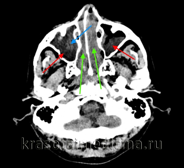 Пансинусит