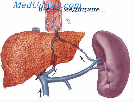 застойная селезенка