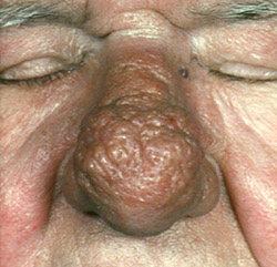 узлы ринофимы