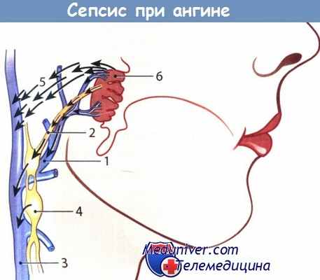 Развитие сепсиса при ангине