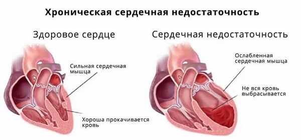 Хроническая сердечная недостаточность внутрь статьи