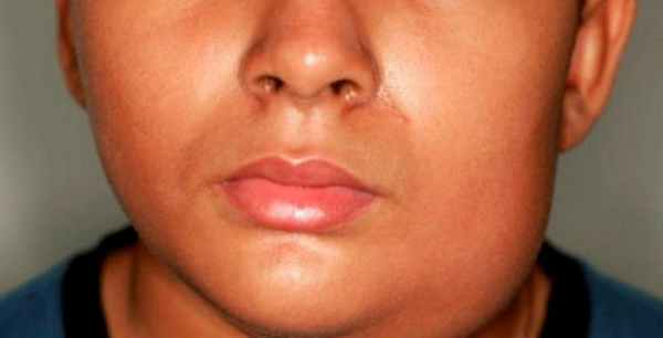 болезнь и синдром микулича 