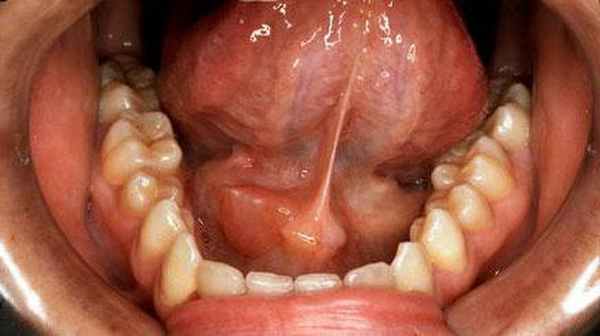 болезнь микулича лечение 