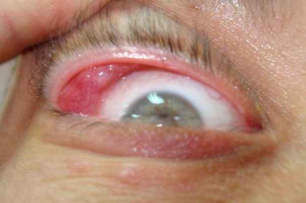 болезнь микулича симптомы 