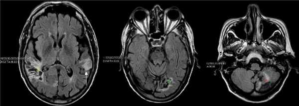 диагностика агнозии