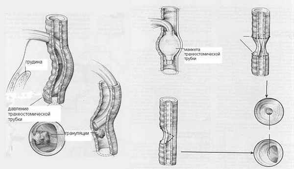 Механизм формирования стеноза трахеи