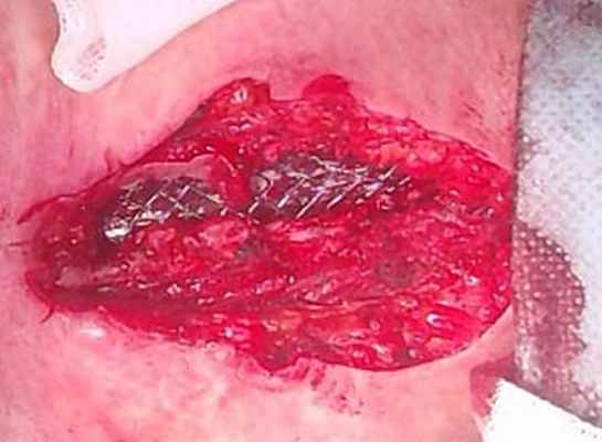 Трахеальный стент в просвете трахеи.