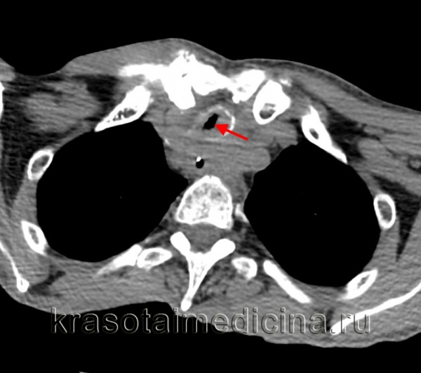 Торакальная хирургия