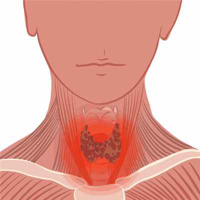 Воспаление щитовидной железы.jpg
