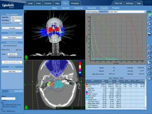 Вестибулярная шваннома: лечение в Киеве на КиберНоже без операции