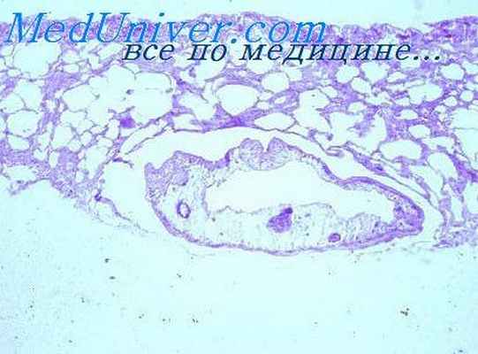 хронический парагонимоз