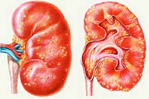 наследственный нефрит