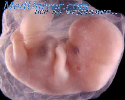 синдром арнольда-киари