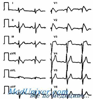 синдром бругада