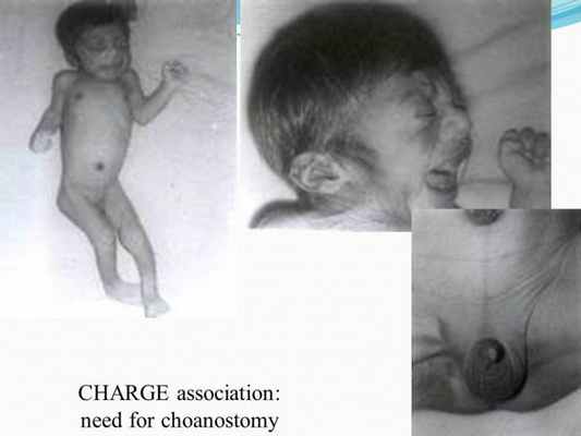 Презентация - Синдром CHARGE (Холла-Хитнера)