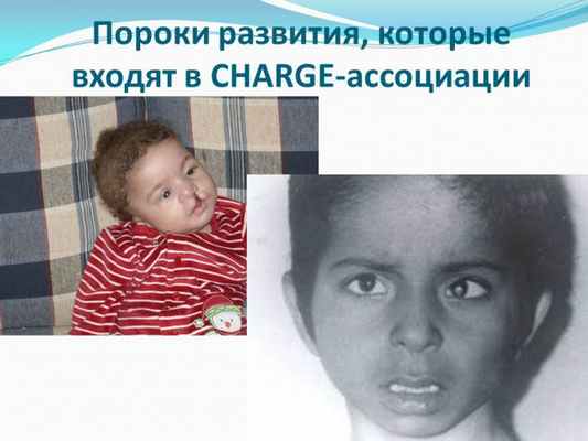 Презентация - Синдром CHARGE (Холла-Хитнера)