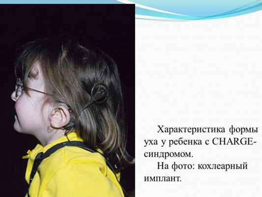 Презентация - Синдром CHARGE (Холла-Хитнера)