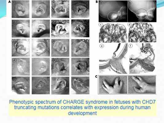 Презентация - Синдром CHARGE (Холла-Хитнера)