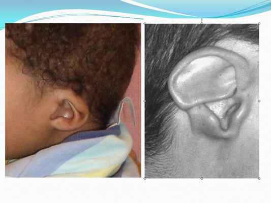 Презентация - Синдром CHARGE (Холла-Хитнера)